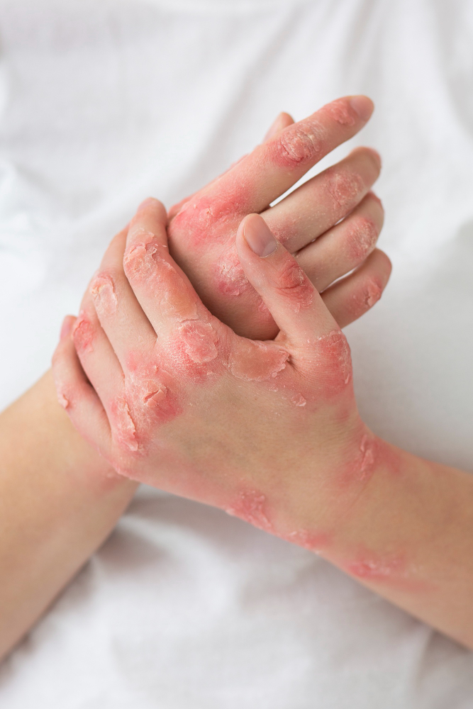 Psoriatic Arthritis