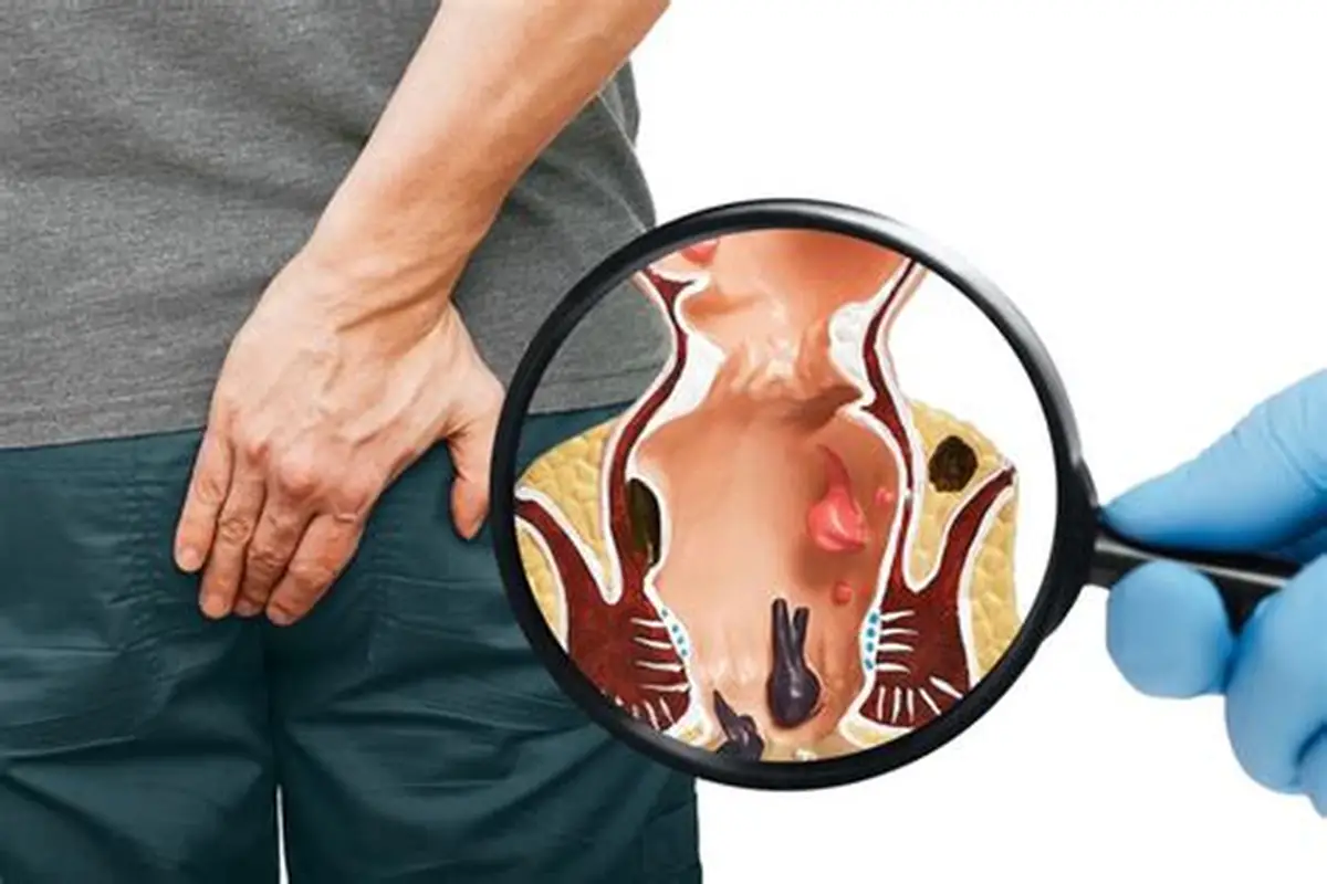 Hemorrhoids