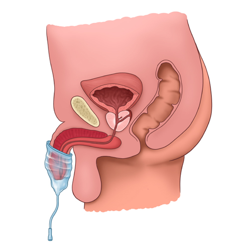 Penis Atrophy