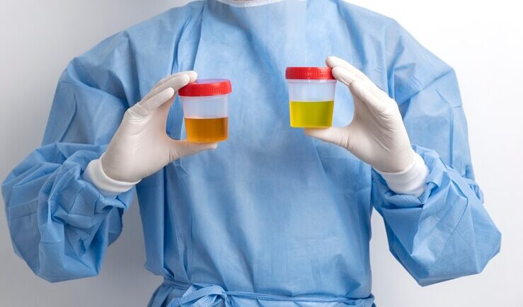 Uric acid