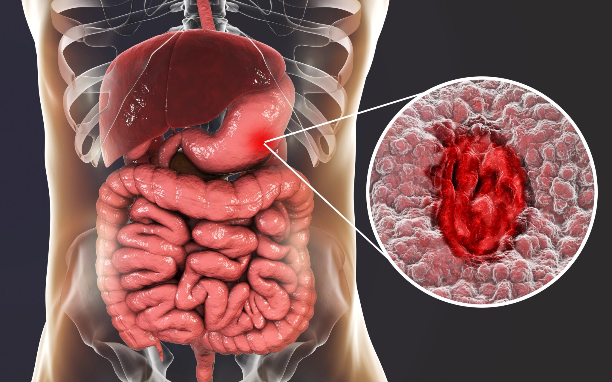 Mystery of Ulcers