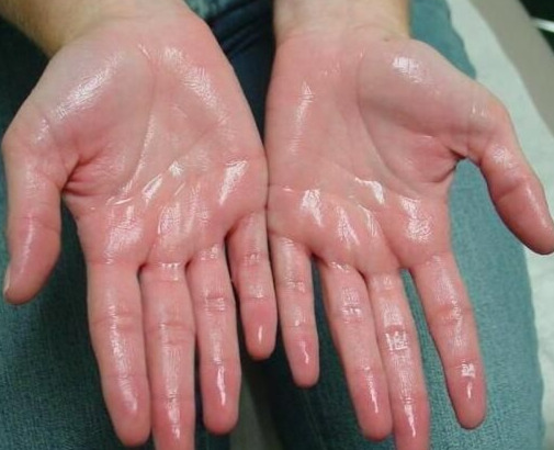 Hyperhidrosis