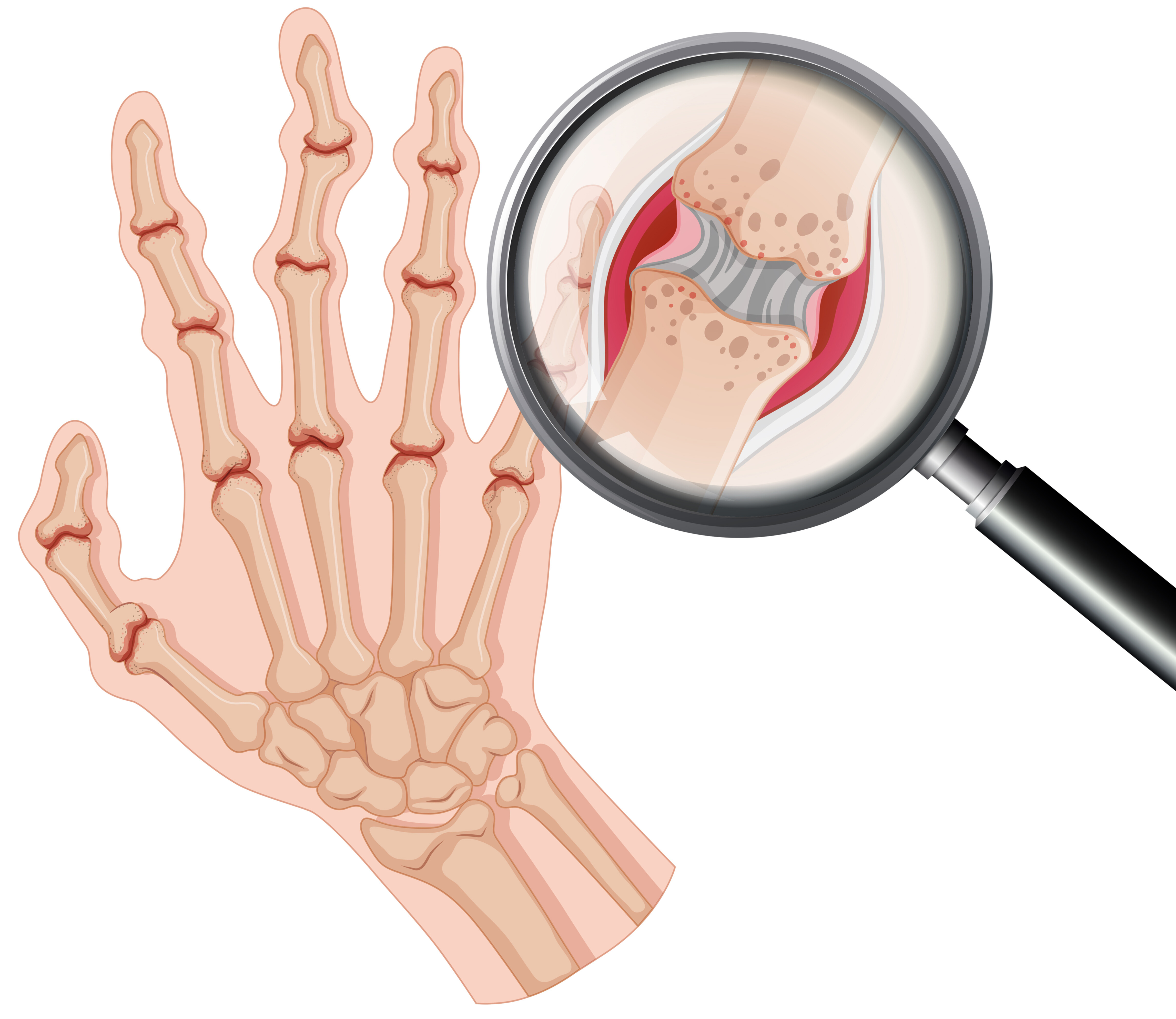 Rheumatoid Arthritis